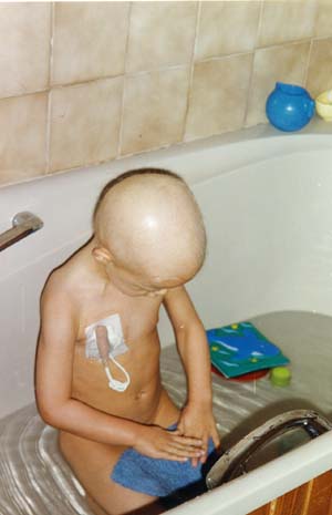 Aplasie f�brile, d�cembre 98